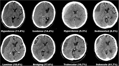 Seizure after surgical treatment of chronic subdural hematoma—Associated factors and effect on outcome
